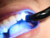 Преимущества лазерного отбеливания зубов