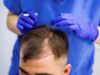 Пересадка волос: как быстро ждать результатов
