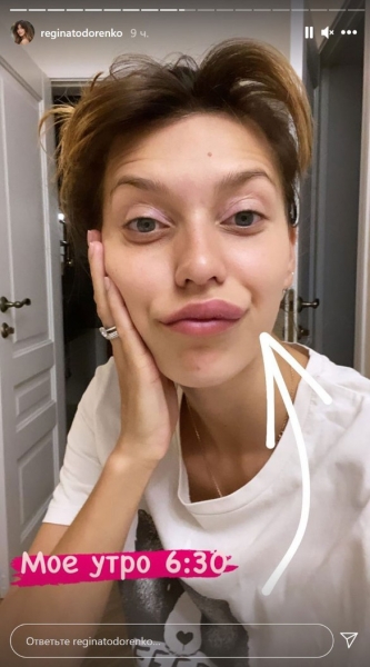Побитая Тодоренко ужаснула опухолью на лице