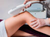 Как выполняется лазерное удаление волос