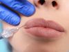 Контурная пластика губ: особенности процедуры