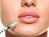Об увеличении губ филлерами с гиалуронкой
