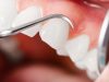 Пародонтологическая чистка зубов: что это такое? Порядок и особенности проведения