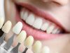 Виниры: изучаем их назначение, показания к применению и преимущества