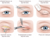 Что такое жиросохраняющая блефаропластика и в каких случаях применяется