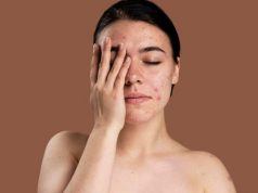 Прыщи у взрослых: почему высыпания не проходят после 25 лет